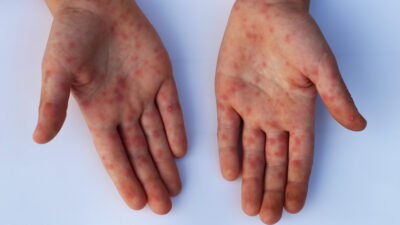 Ilustrasi gejala flu singapura. FOTO: klikdokter